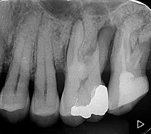 Radiografia periapical de dente com tratamento de canal