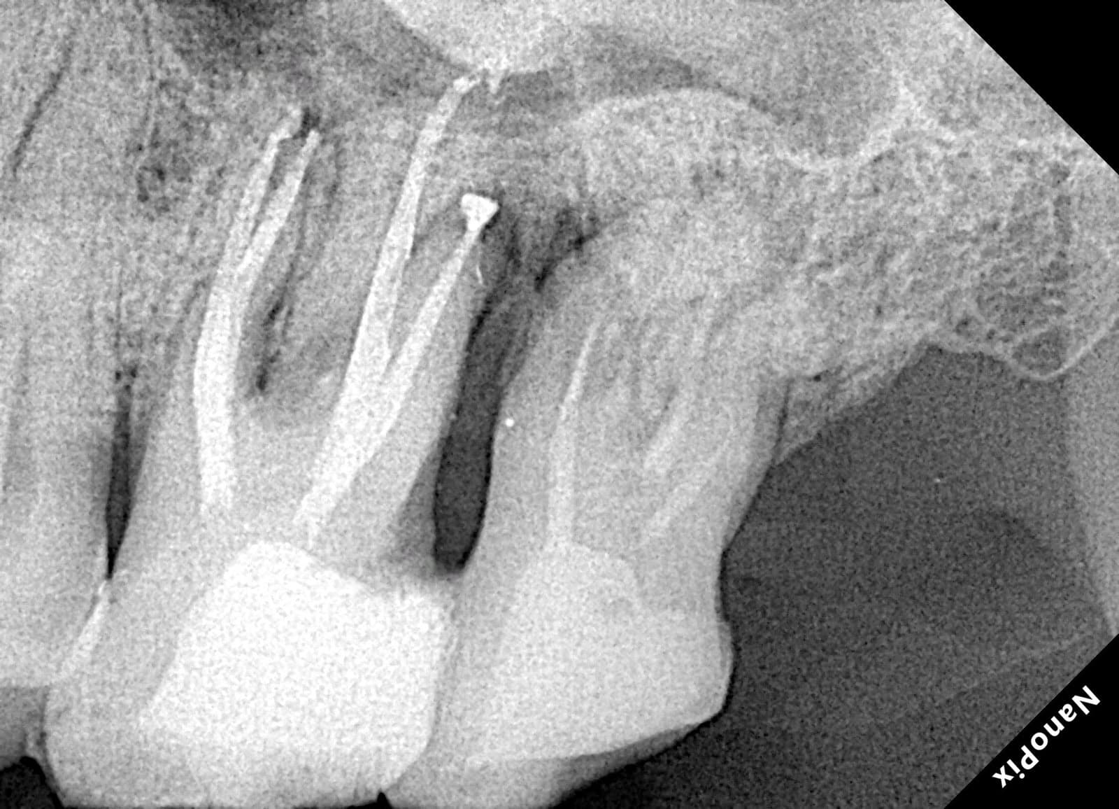 Radiografia ampliada mostrando os canais radiculares tratados