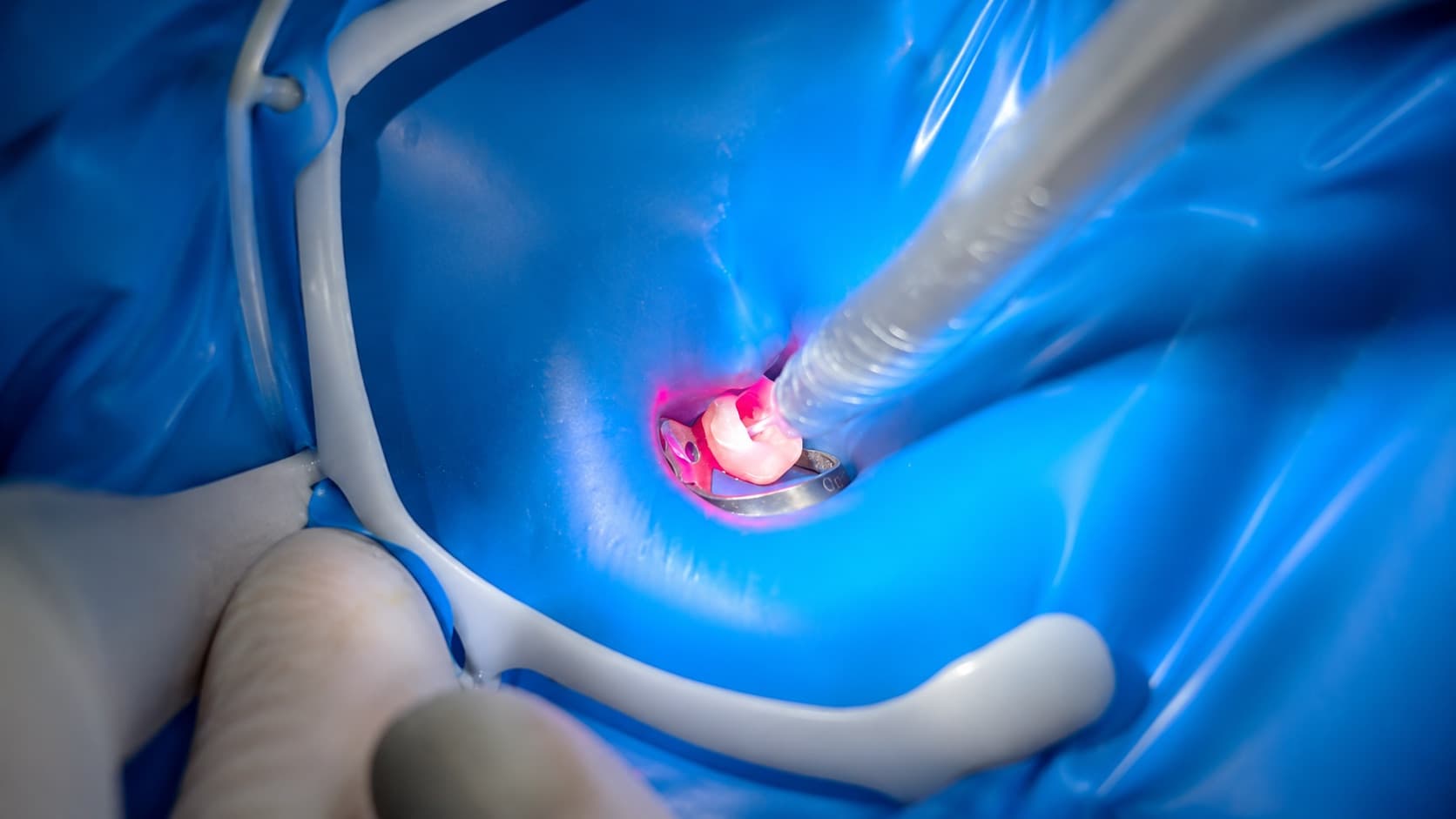 Descontaminação a laser no tratamento de canal: o que é e quando ajuda